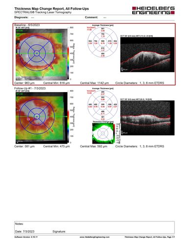 central retinal vein occlusion - a lot of hemorrhage - on coumadin
84 year old man with severe vision loss left eye for 2 weeks.  VA 5/200 OS - Patient on Warfarin for valve replacement.
