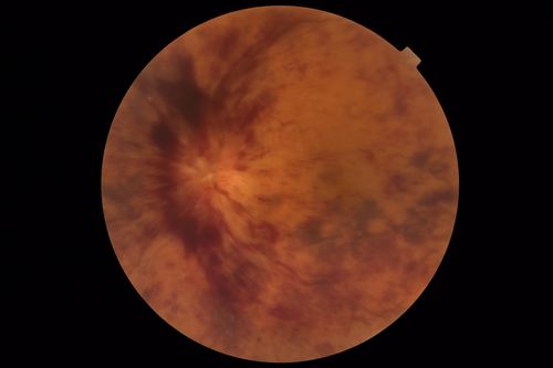 Central Retinal Vein Occlusion with Macular Edema
74 year old female The vision in the left eye has gotten worse over the last 3 weeks.  
VA OD: Dcc20/25 
VA OS: DccCF 3ft 
IOP: TP: OD:16 OS:14 
Vision improved to 20/40 in 3 months with monthly Aflibercept
