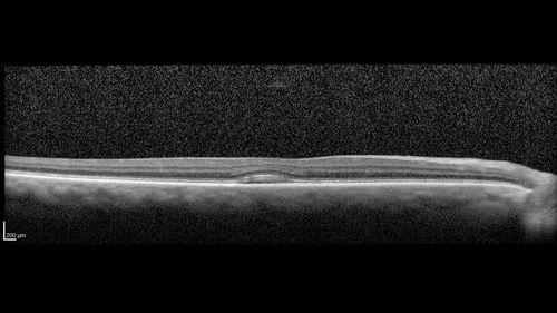 Central Retinal Vein Occlusion with Macular Edema
74 year old female The vision in the left eye has gotten worse over the last 3 weeks.  
VA OD: Dcc20/25 
VA OS: DccCF 3ft 
IOP: TP: OD:16 OS:14 
Vision improved to 20/40 in 3 months with monthly Aflibercept
