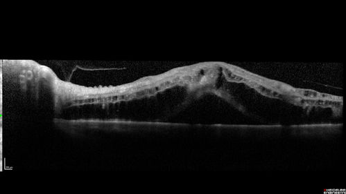 Central Retinal Vein Occlusion with Macular Edema
74 year old female The vision in the left eye has gotten worse over the last 3 weeks.  
VA OD: Dcc20/25 
VA OS: DccCF 3ft 
IOP: TP: OD:16 OS:14 
Vision improved to 20/40 in 3 months with monthly Aflibercept
