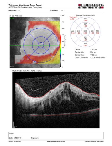 Central Retinal Vein Occlusion with Macular Edema
74 year old female The vision in the left eye has gotten worse over the last 3 weeks.  
VA OD: Dcc20/25 
VA OS: DccCF 3ft 
IOP: TP: OD:16 OS:14 
Vision improved to 20/40 in 3 months with monthly Aflibercept
