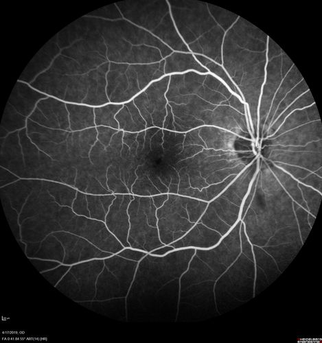Central Retinal Vein Occlusion with Macular Edema
74 year old female The vision in the left eye has gotten worse over the last 3 weeks.  
VA OD: Dcc20/25 
VA OS: DccCF 3ft 
IOP: TP: OD:16 OS:14 
Vision improved to 20/40 in 3 months with monthly Aflibercept
