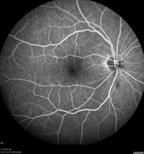 Central Retinal Vein Occlusion with Macular Edema
74 year old female The vision in the left eye has gotten worse over the last 3 weeks.  
VA OD: Dcc20/25 
VA OS: DccCF 3ft 
IOP: TP: OD:16 OS:14 
Vision improved to 20/40 in 3 months with monthly Aflibercept

