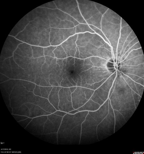 Central Retinal Vein Occlusion with Macular Edema
74 year old female The vision in the left eye has gotten worse over the last 3 weeks.  
VA OD: Dcc20/25 
VA OS: DccCF 3ft 
IOP: TP: OD:16 OS:14 
Vision improved to 20/40 in 3 months with monthly Aflibercept
