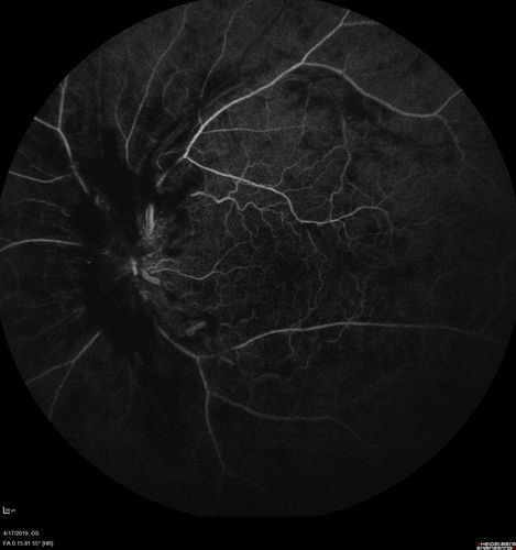 Central Retinal Vein Occlusion with Macular Edema
74 year old female The vision in the left eye has gotten worse over the last 3 weeks.  
VA OD: Dcc20/25 
VA OS: DccCF 3ft 
IOP: TP: OD:16 OS:14 
Vision improved to 20/40 in 3 months with monthly Aflibercept
