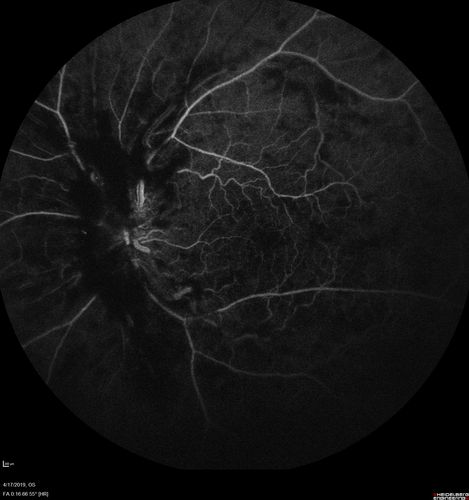 Central Retinal Vein Occlusion with Macular Edema
74 year old female The vision in the left eye has gotten worse over the last 3 weeks.  
VA OD: Dcc20/25 
VA OS: DccCF 3ft 
IOP: TP: OD:16 OS:14 
Vision improved to 20/40 in 3 months with monthly Aflibercept
