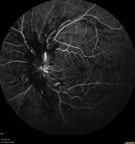 Central Retinal Vein Occlusion with Macular Edema
74 year old female The vision in the left eye has gotten worse over the last 3 weeks.  
VA OD: Dcc20/25 
VA OS: DccCF 3ft 
IOP: TP: OD:16 OS:14 
Vision improved to 20/40 in 3 months with monthly Aflibercept
