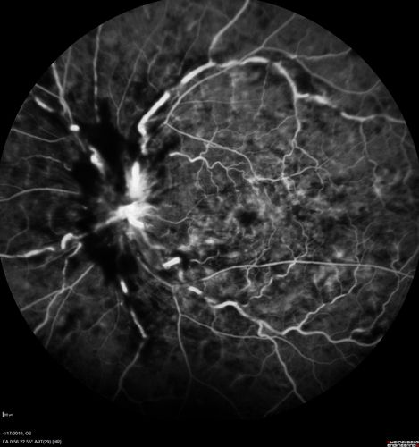 Central Retinal Vein Occlusion with Macular Edema
74 year old female The vision in the left eye has gotten worse over the last 3 weeks.  
VA OD: Dcc20/25 
VA OS: DccCF 3ft 
IOP: TP: OD:16 OS:14 
Vision improved to 20/40 in 3 months with monthly Aflibercept
