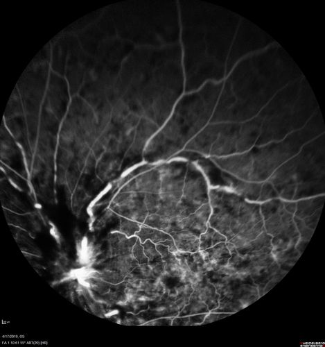 Central Retinal Vein Occlusion with Macular Edema
74 year old female The vision in the left eye has gotten worse over the last 3 weeks.  
VA OD: Dcc20/25 
VA OS: DccCF 3ft 
IOP: TP: OD:16 OS:14 
Vision improved to 20/40 in 3 months with monthly Aflibercept
