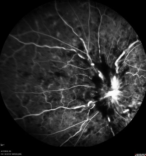 Central Retinal Vein Occlusion with Macular Edema
74 year old female The vision in the left eye has gotten worse over the last 3 weeks.  
VA OD: Dcc20/25 
VA OS: DccCF 3ft 
IOP: TP: OD:16 OS:14 
Vision improved to 20/40 in 3 months with monthly Aflibercept
