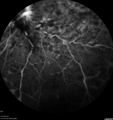 Central Retinal Vein Occlusion with Macular Edema
74 year old female The vision in the left eye has gotten worse over the last 3 weeks.  
VA OD: Dcc20/25 
VA OS: DccCF 3ft 
IOP: TP: OD:16 OS:14 
Vision improved to 20/40 in 3 months with monthly Aflibercept
