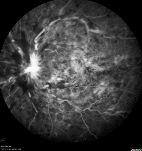 Central Retinal Vein Occlusion with Macular Edema
74 year old female The vision in the left eye has gotten worse over the last 3 weeks.  
VA OD: Dcc20/25 
VA OS: DccCF 3ft 
IOP: TP: OD:16 OS:14 
Vision improved to 20/40 in 3 months with monthly Aflibercept
