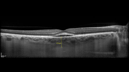 Mild Central Serous Chorioretinopathy - Flonase related
58 year old man with vision loss in the left eye for 8 days.  This has never happened before. He started taking flonase about a month ago.  He stopped the flonase and the vision improved in less than a month.  Initial vision was 20/20 OD, 20/40 OS
