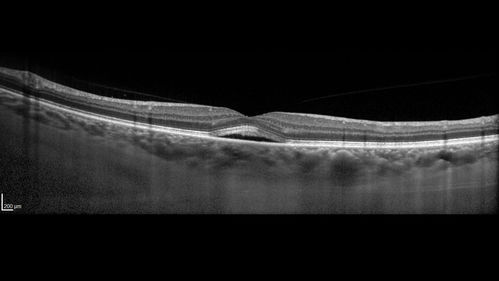 Mild Central Serous Chorioretinopathy - Flonase related
58 year old man with vision loss in the left eye for 8 days.  This has never happened before. He started taking flonase about a month ago.  He stopped the flonase and the vision improved in less than a month.  Initial vision was 20/20 OD, 20/40 OS
