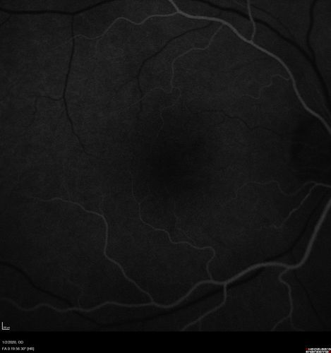 Mild Central Serous Chorioretinopathy - Flonase related
58 year old man with vision loss in the left eye for 8 days.  This has never happened before. He started taking flonase about a month ago.  He stopped the flonase and the vision improved in less than a month.  Initial vision was 20/20 OD, 20/40 OS
