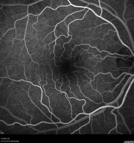Mild Central Serous Chorioretinopathy - Flonase related
58 year old man with vision loss in the left eye for 8 days.  This has never happened before. He started taking flonase about a month ago.  He stopped the flonase and the vision improved in less than a month.  Initial vision was 20/20 OD, 20/40 OS
