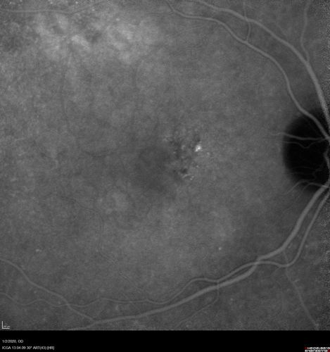 Mild Central Serous Chorioretinopathy - Flonase related
58 year old man with vision loss in the left eye for 8 days.  This has never happened before. He started taking flonase about a month ago.  He stopped the flonase and the vision improved in less than a month.  Initial vision was 20/20 OD, 20/40 OS
