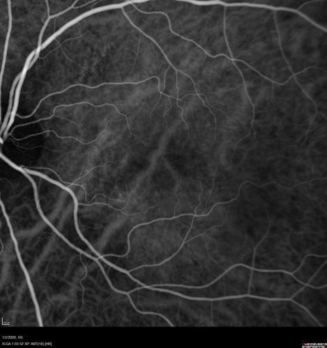 Mild Central Serous Chorioretinopathy - Flonase related
58 year old man with vision loss in the left eye for 8 days.  This has never happened before. He started taking flonase about a month ago.  He stopped the flonase and the vision improved in less than a month.  Initial vision was 20/20 OD, 20/40 OS
