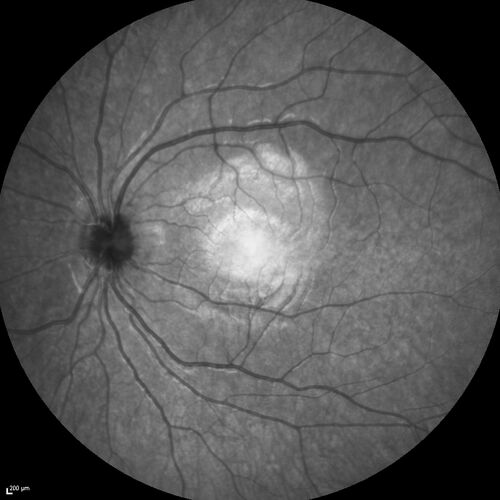 Central Serous Chorioretinopathy in a child
12-year-old African American Female A few weeks ago she felt like something was covering the right eye and she couldn't see well. She was told that she had a swollen optic nerve. She had a recent diagnosis of sinus infection. She also recently had onset menarche on August 7th. Eye problem started about a week before menarche. She's been getting some headaches, partly because of sinus infection. They started about a month ago and now are getting better. She is on zytrhomax for the sinus problem. Patient is hypothyroid and is on thyroid supplementation and that has been stable. She has no eye pain.
MEDS: Synthroid, Flonase
PMHx -  Thyroid Disease
VA OD: Dcc20/400 PH20/125 NccJ10
VA OS: Dcc20/20 NccJ1+
IOP: TP: OD:14 OS:21 

Macular detachments resolved in 1 month with no treatment and vision returned to 20/20 in one month and 20/16 in 2 months

