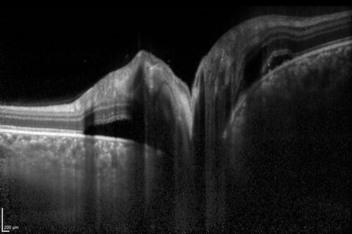 Central Serous Chorioretinopathy in a child
12-year-old African American Female A few weeks ago she felt like something was covering the right eye and she couldn't see well. She was told that she had a swollen optic nerve. She had a recent diagnosis of sinus infection. She also recently had onset menarche on August 7th. Eye problem started about a week before menarche. She's been getting some headaches, partly because of sinus infection. They started about a month ago and now are getting better. She is on zytrhomax for the sinus problem. Patient is hypothyroid and is on thyroid supplementation and that has been stable. She has no eye pain.
MEDS: Synthroid, Flonase
PMHx -  Thyroid Disease
VA OD: Dcc20/400 PH20/125 NccJ10
VA OS: Dcc20/20 NccJ1+
IOP: TP: OD:14 OS:21 

Macular detachments resolved in 1 month with no treatment and vision returned to 20/20 in one month and 20/16 in 2 months
