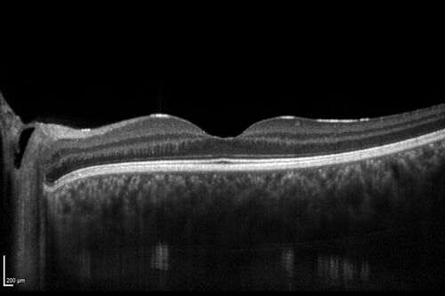 Central Serous Chorioretinopathy in a child
12-year-old African American Female A few weeks ago she felt like something was covering the right eye and she couldn't see well. She was told that she had a swollen optic nerve. She had a recent diagnosis of sinus infection. She also recently had onset menarche on August 7th. Eye problem started about a week before menarche. She's been getting some headaches, partly because of sinus infection. They started about a month ago and now are getting better. She is on zytrhomax for the sinus problem. Patient is hypothyroid and is on thyroid supplementation and that has been stable. She has no eye pain.
MEDS: Synthroid, Flonase
PMHx -  Thyroid Disease
VA OD: Dcc20/400 PH20/125 NccJ10
VA OS: Dcc20/20 NccJ1+
IOP: TP: OD:14 OS:21 

Macular detachments resolved in 1 month with no treatment and vision returned to 20/20 in one month and 20/16 in 2 months
