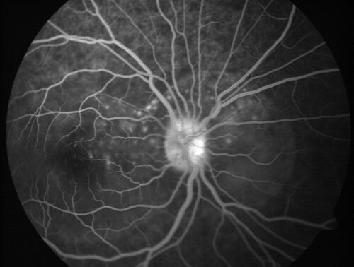 Central Serous Chorioretinopathy in a child
12-year-old African American Female A few weeks ago she felt like something was covering the right eye and she couldn't see well. She was told that she had a swollen optic nerve. She had a recent diagnosis of sinus infection. She also recently had onset menarche on August 7th. Eye problem started about a week before menarche. She's been getting some headaches, partly because of sinus infection. They started about a month ago and now are getting better. She is on zytrhomax for the sinus problem. Patient is hypothyroid and is on thyroid supplementation and that has been stable. She has no eye pain.
MEDS: Synthroid, Flonase
PMHx -  Thyroid Disease
VA OD: Dcc20/400 PH20/125 NccJ10
VA OS: Dcc20/20 NccJ1+
IOP: TP: OD:14 OS:21 

Macular detachments resolved in 1 month with no treatment and vision returned to 20/20 in one month and 20/16 in 2 months
