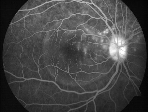Central Serous Chorioretinopathy in a child
12-year-old African American Female A few weeks ago she felt like something was covering the right eye and she couldn't see well. She was told that she had a swollen optic nerve. She had a recent diagnosis of sinus infection. She also recently had onset menarche on August 7th. Eye problem started about a week before menarche. She's been getting some headaches, partly because of sinus infection. They started about a month ago and now are getting better. She is on zytrhomax for the sinus problem. Patient is hypothyroid and is on thyroid supplementation and that has been stable. She has no eye pain.
MEDS: Synthroid, Flonase
PMHx -  Thyroid Disease
VA OD: Dcc20/400 PH20/125 NccJ10
VA OS: Dcc20/20 NccJ1+
IOP: TP: OD:14 OS:21 

Macular detachments resolved in 1 month with no treatment and vision returned to 20/20 in one month and 20/16 in 2 months
