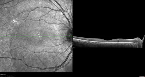 Central Serous Chorioretinopathy in a child
12-year-old African American Female A few weeks ago she felt like something was covering the right eye and she couldn't see well. She was told that she had a swollen optic nerve. She had a recent diagnosis of sinus infection. She also recently had onset menarche on August 7th. Eye problem started about a week before menarche. She's been getting some headaches, partly because of sinus infection. They started about a month ago and now are getting better. She is on zytrhomax for the sinus problem. Patient is hypothyroid and is on thyroid supplementation and that has been stable. She has no eye pain.
MEDS: Synthroid, Flonase
PMHx -  Thyroid Disease
VA OD: Dcc20/400 PH20/125 NccJ10
VA OS: Dcc20/20 NccJ1+
IOP: TP: OD:14 OS:21 

Macular detachments resolved in 1 month with no treatment and vision returned to 20/20 in one month and 20/16 in 2 months
