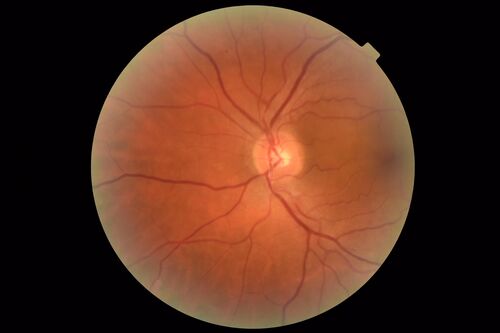 Bilateral Acute Central Serous Chorioretinopathy - Evidence of old disease OS
64 year old man  noticed in the right eye that is a black spot 4 days ago.  Also vertical lines in his kitchen were a little wavy. He is not on any steroid medications.  He has vertigo. 
VA OD: Dcc20/25-2 NccJ1+-3
VA OS: Dcc20/32-1 PHNI NccJ5-1
IOP: TP: OD:12 OS:15

