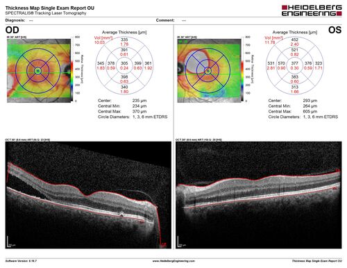 Bilateral Acute Central Serous Chorioretinopathy - Evidence of old disease OS
64 year old man  noticed in the right eye that is a black spot 4 days ago.  Also vertical lines in his kitchen were a little wavy. He is not on any steroid medications.  He has vertigo. 
VA OD: Dcc20/25-2 NccJ1+-3
VA OS: Dcc20/32-1 PHNI NccJ5-1
IOP: TP: OD:12 OS:15
