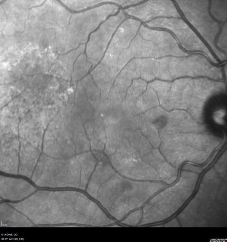 Bilateral Acute Central Serous Chorioretinopathy - Evidence of old disease OS
64 year old man  noticed in the right eye that is a black spot 4 days ago.  Also vertical lines in his kitchen were a little wavy. He is not on any steroid medications.  He has vertigo. 
VA OD: Dcc20/25-2 NccJ1+-3
VA OS: Dcc20/32-1 PHNI NccJ5-1
IOP: TP: OD:12 OS:15

