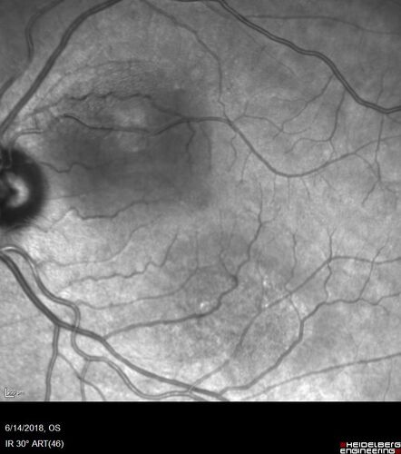 Bilateral Acute Central Serous Chorioretinopathy - Evidence of old disease OS
64 year old man  noticed in the right eye that is a black spot 4 days ago.  Also vertical lines in his kitchen were a little wavy. He is not on any steroid medications.  He has vertigo. 
VA OD: Dcc20/25-2 NccJ1+-3
VA OS: Dcc20/32-1 PHNI NccJ5-1
IOP: TP: OD:12 OS:15

