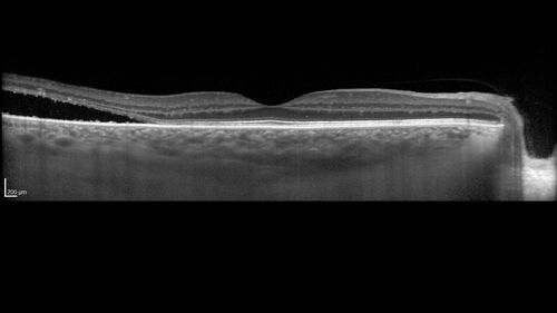 Bilateral Acute Central Serous Chorioretinopathy - Evidence of old disease OS
64 year old man  noticed in the right eye that is a black spot 4 days ago.  Also vertical lines in his kitchen were a little wavy. He is not on any steroid medications.  He has vertigo. 
VA OD: Dcc20/25-2 NccJ1+-3
VA OS: Dcc20/32-1 PHNI NccJ5-1
IOP: TP: OD:12 OS:15
