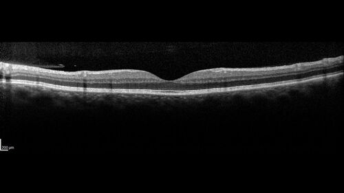 Bilateral Acute Central Serous Chorioretinopathy - Evidence of old disease OS
64 year old man  noticed in the right eye that is a black spot 4 days ago.  Also vertical lines in his kitchen were a little wavy. He is not on any steroid medications.  He has vertigo. 
VA OD: Dcc20/25-2 NccJ1+-3
VA OS: Dcc20/32-1 PHNI NccJ5-1
IOP: TP: OD:12 OS:15
