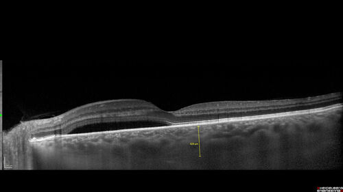 Bilateral Acute Central Serous Chorioretinopathy - Evidence of old disease OS
64 year old man  noticed in the right eye that is a black spot 4 days ago.  Also vertical lines in his kitchen were a little wavy. He is not on any steroid medications.  He has vertigo. 
VA OD: Dcc20/25-2 NccJ1+-3
VA OS: Dcc20/32-1 PHNI NccJ5-1
IOP: TP: OD:12 OS:15
