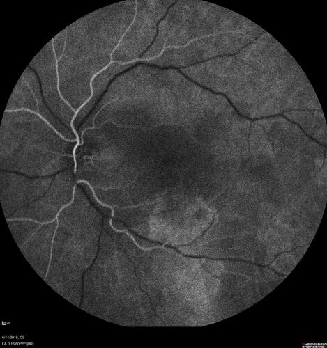 Bilateral Acute Central Serous Chorioretinopathy - Evidence of old disease OS
64 year old man  noticed in the right eye that is a black spot 4 days ago.  Also vertical lines in his kitchen were a little wavy. He is not on any steroid medications.  He has vertigo. 
VA OD: Dcc20/25-2 NccJ1+-3
VA OS: Dcc20/32-1 PHNI NccJ5-1
IOP: TP: OD:12 OS:15
