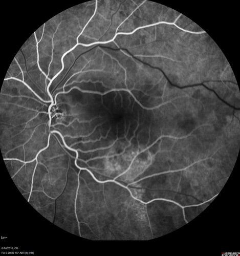 Bilateral Acute Central Serous Chorioretinopathy - Evidence of old disease OS
64 year old man  noticed in the right eye that is a black spot 4 days ago.  Also vertical lines in his kitchen were a little wavy. He is not on any steroid medications.  He has vertigo. 
VA OD: Dcc20/25-2 NccJ1+-3
VA OS: Dcc20/32-1 PHNI NccJ5-1
IOP: TP: OD:12 OS:15
