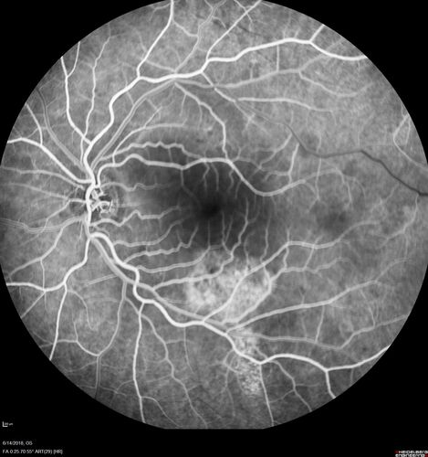 Bilateral Acute Central Serous Chorioretinopathy - Evidence of old disease OS
64 year old man  noticed in the right eye that is a black spot 4 days ago.  Also vertical lines in his kitchen were a little wavy. He is not on any steroid medications.  He has vertigo. 
VA OD: Dcc20/25-2 NccJ1+-3
VA OS: Dcc20/32-1 PHNI NccJ5-1
IOP: TP: OD:12 OS:15
