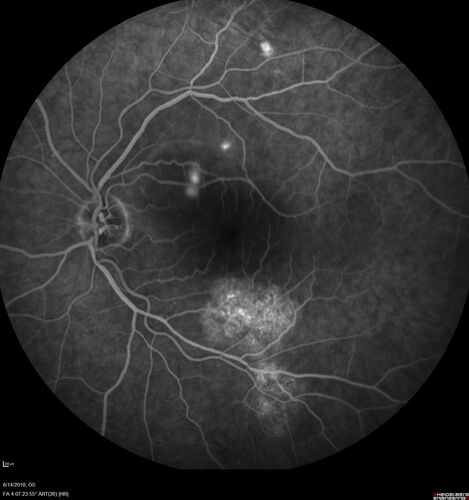 Bilateral Acute Central Serous Chorioretinopathy - Evidence of old disease OS
64 year old man  noticed in the right eye that is a black spot 4 days ago.  Also vertical lines in his kitchen were a little wavy. He is not on any steroid medications.  He has vertigo. 
VA OD: Dcc20/25-2 NccJ1+-3
VA OS: Dcc20/32-1 PHNI NccJ5-1
IOP: TP: OD:12 OS:15
