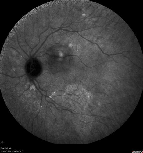 Bilateral Acute Central Serous Chorioretinopathy - Evidence of old disease OS
64 year old man  noticed in the right eye that is a black spot 4 days ago.  Also vertical lines in his kitchen were a little wavy. He is not on any steroid medications.  He has vertigo. 
VA OD: Dcc20/25-2 NccJ1+-3
VA OS: Dcc20/32-1 PHNI NccJ5-1
IOP: TP: OD:12 OS:15
