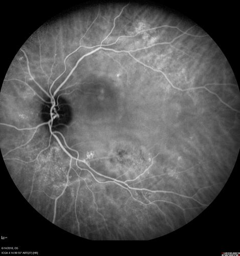 Bilateral Acute Central Serous Chorioretinopathy - Evidence of old disease OS
64 year old man  noticed in the right eye that is a black spot 4 days ago.  Also vertical lines in his kitchen were a little wavy. He is not on any steroid medications.  He has vertigo. 
VA OD: Dcc20/25-2 NccJ1+-3
VA OS: Dcc20/32-1 PHNI NccJ5-1
IOP: TP: OD:12 OS:15
