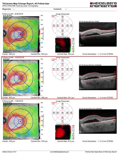 Bilateral Acute Central Serous Chorioretinopathy - Evidence of old disease OS
64 year old man  noticed in the right eye that is a black spot 4 days ago.  Also vertical lines in his kitchen were a little wavy. He is not on any steroid medications.  He has vertigo. 
VA OD: Dcc20/25-2 NccJ1+-3
VA OS: Dcc20/32-1 PHNI NccJ5-1
IOP: TP: OD:12 OS:15
