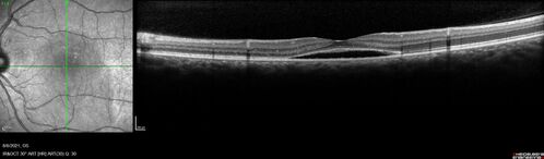 Central Serous Chorioretinopathy - Expanding hot spot - photodynamic laser
35 year old man with acute central serous chorioretinopathy.  The fluid got better then worse and the patient was treated with full strength juxtafoveal PDT and then got better.
