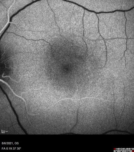 Central Serous Chorioretinopathy - Expanding hot spot - photodynamic laser
35 year old man with acute central serous chorioretinopathy.  The fluid got better then worse and the patient was treated with full strength juxtafoveal PDT and then got better.
