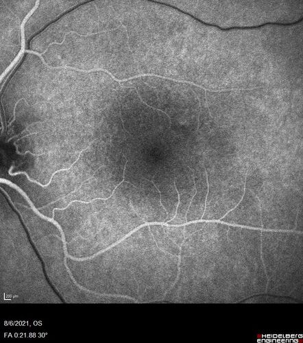 Central Serous Chorioretinopathy - Expanding hot spot - photodynamic laser
35 year old man with acute central serous chorioretinopathy.  The fluid got better then worse and the patient was treated with full strength juxtafoveal PDT and then got better.
