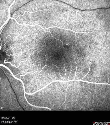 Central Serous Chorioretinopathy - Expanding hot spot - photodynamic laser
35 year old man with acute central serous chorioretinopathy.  The fluid got better then worse and the patient was treated with full strength juxtafoveal PDT and then got better.
