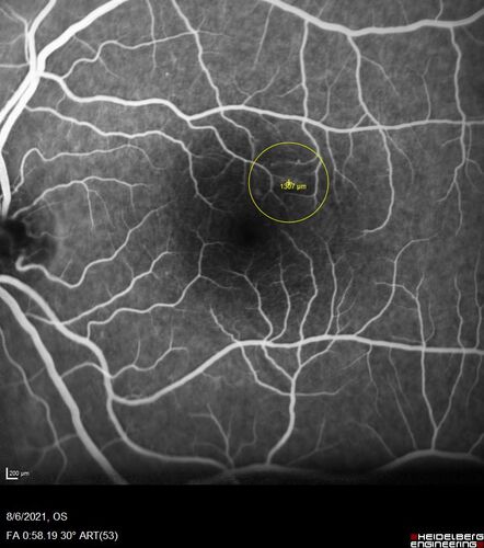 Central Serous Chorioretinopathy - Expanding hot spot - photodynamic laser
35 year old man with acute central serous chorioretinopathy.  The fluid got better then worse and the patient was treated with full strength juxtafoveal PDT and then got better.
