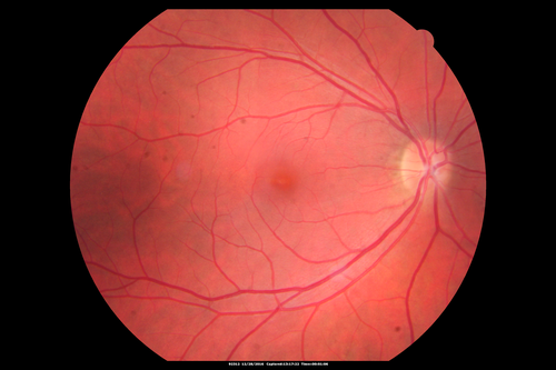 Central Serous Retinopathy - Female on steroids
35 year old female Noticed blurred vision when waking up in the morning.  Also, vision blacks out for a few seconds when she gets up quickly. About 3 months ago she had a history of intermittent vomiting.

VA 20/20 OD, 20/25 OS

MRI normal,  MRA showed lateral sinus thrombosis.  Lupus anticoagulant was positive

