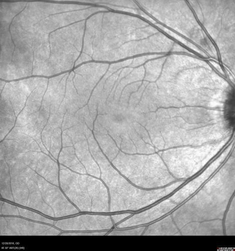 Central Serous Retinopathy - Female on steroids
35 year old female Noticed blurred vision when waking up in the morning.  Also, vision blacks out for a few seconds when she gets up quickly. About 3 months ago she had a history of intermittent vomiting.

VA 20/20 OD, 20/25 OS

MRI normal,  MRA showed lateral sinus thrombosis.  Lupus anticoagulant was positive
