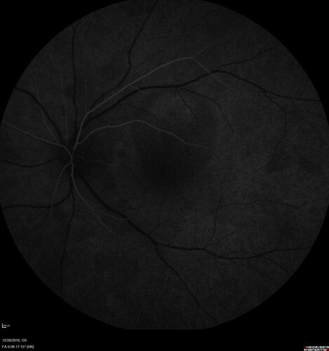 Central Serous Retinopathy - Female on steroids
35 year old female Noticed blurred vision when waking up in the morning.  Also, vision blacks out for a few seconds when she gets up quickly. About 3 months ago she had a history of intermittent vomiting.

VA 20/20 OD, 20/25 OS

MRI normal,  MRA showed lateral sinus thrombosis.  Lupus anticoagulant was positive
